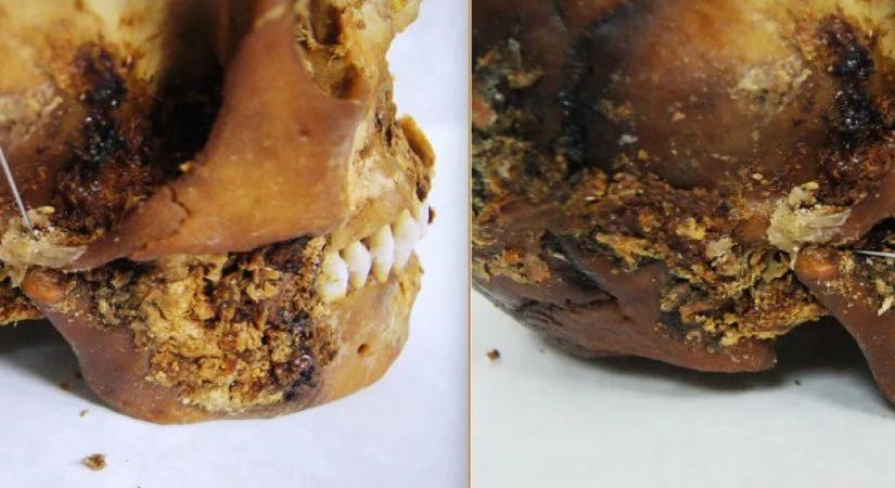 Váratlanul komplex műtétet végeztek 2500 évvel ezelőtt egy, a mai Oroszország területén élt nőn