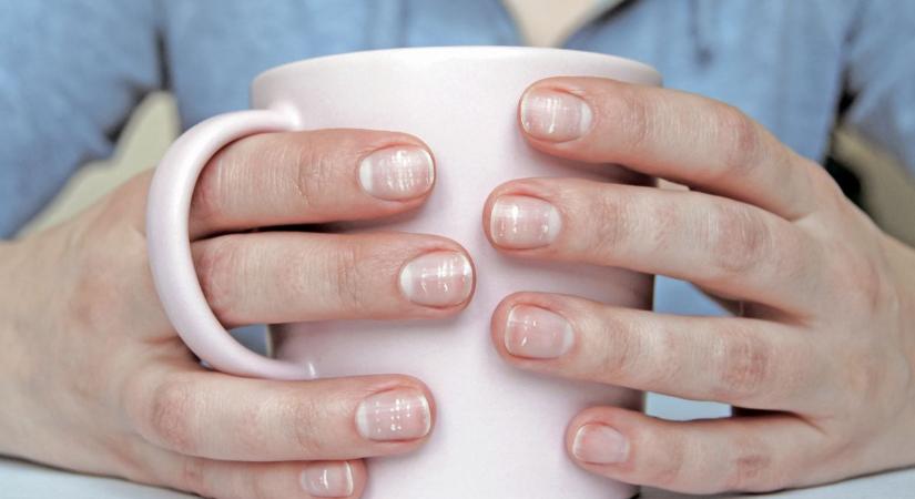 Fehér foltok a körmön? Nem biztos, hogy vitaminhiány