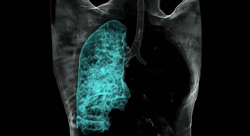 Nagy a baj, cigaretta nélkül is egyre több embernél alakul ki a tüdőrák