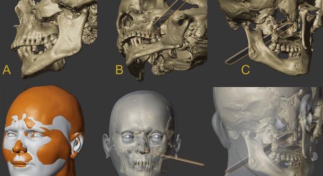 Arcrekonstrukció készült egy középkori horvátországi „vámpírsírban” talált, lefejezett férfiról