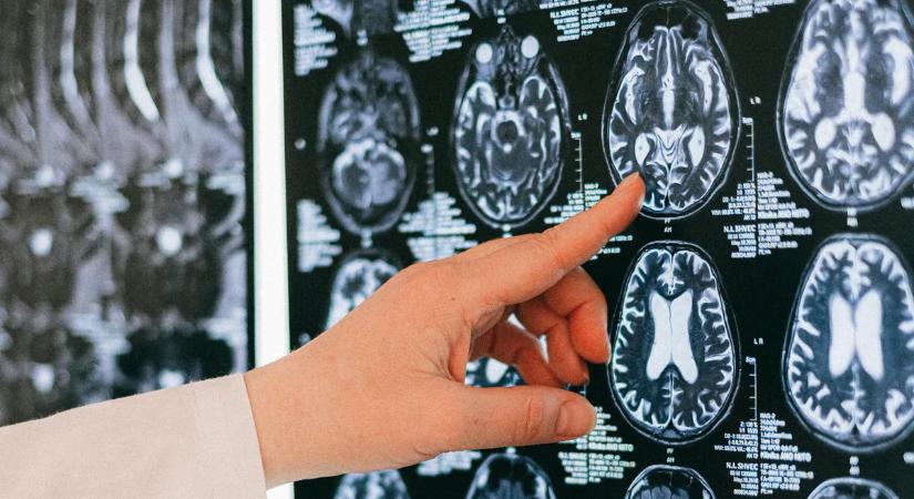Kitálalt a neurológus: ezekkel a módszerekkel tudod elkerülni a demenciát