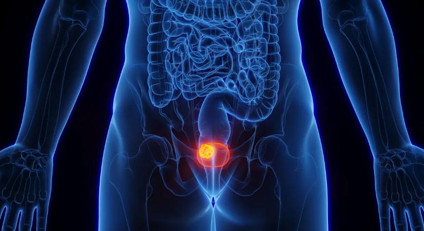 Sokkoló adat: tömegesen diagnosztizálják félre a nőket ezzel a betegséggel