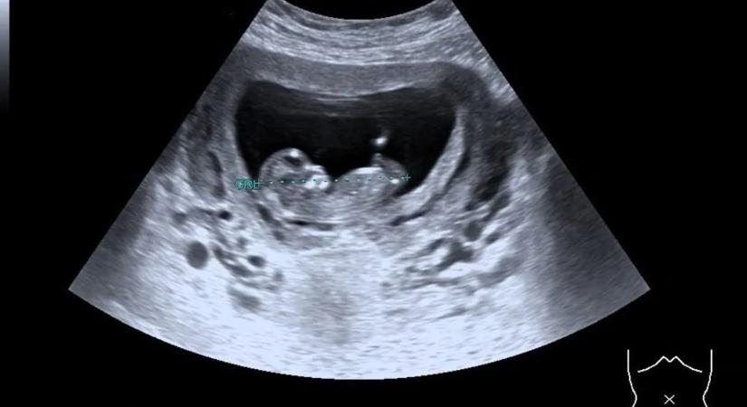 Csodabébi született a halott donorból átültetett méhből