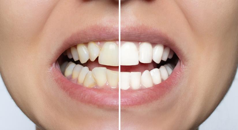Otthoni megoldások fogfehérítésre – mi az, ami tényleg működik?