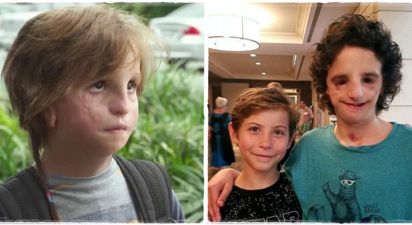 Emlékszel még Az igazi csodára? Így él ma az arcdeformitással született kisfiú, aki inspirálta a filmet