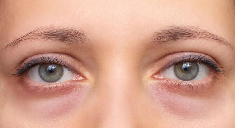 Zavar a szemed alatti duzzanat? Így enyhítheted házi praktikákkal