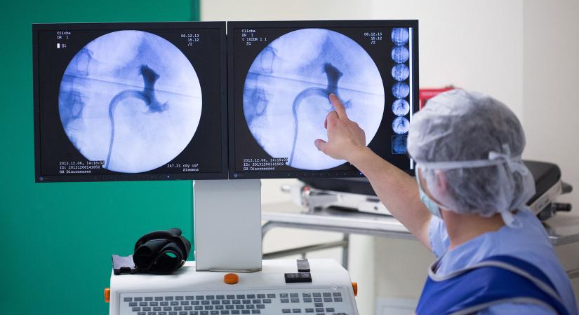 Lehet, hogy idáig végig félreértettük a veseköveket