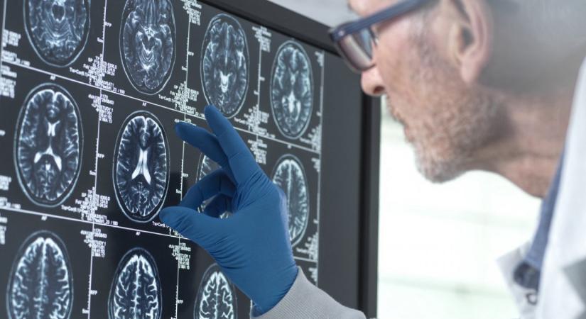 Az Alzheimer-tesztek többet és mást is megmutathatnak, nemcsak a kór jelenlétét