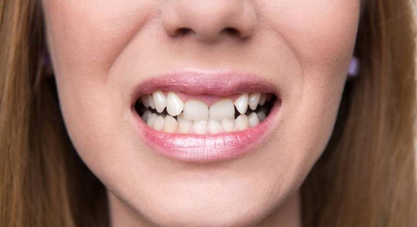 Ez a hétköznapi gyümölcs segít épen tartani a fogaid