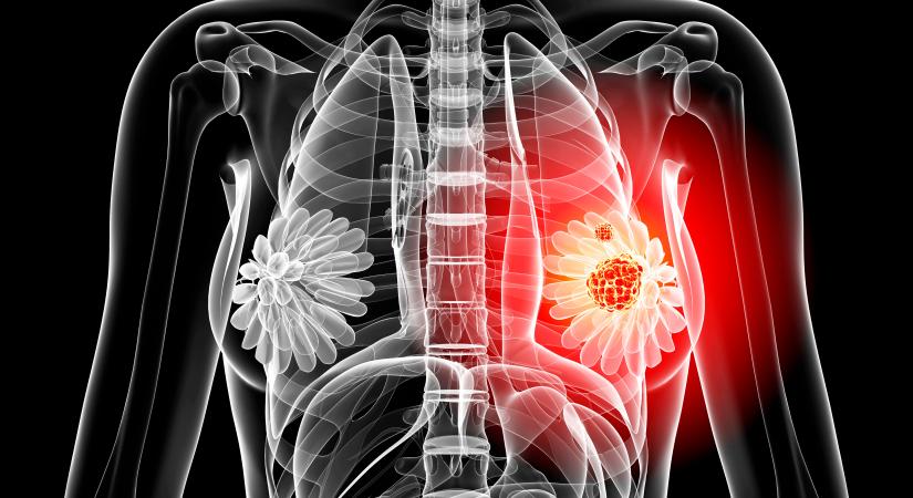 WHO: a mellrák a leggyakoribb daganatos betegséggé vált