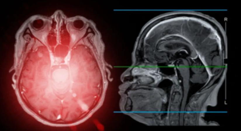 Horror: emberben még sosem látott parazita okozott memóriazavart egy nőnél