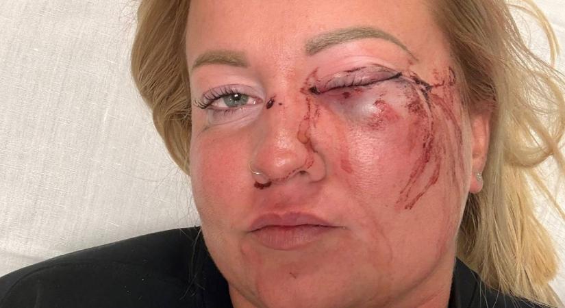 „Lehet, hogy soha többé nem fogok látni a bal szememre” – Gréta azt mondja, hogy megverte a szentmártonkátai alpolgármester a kolbásztöltő fesztiválon