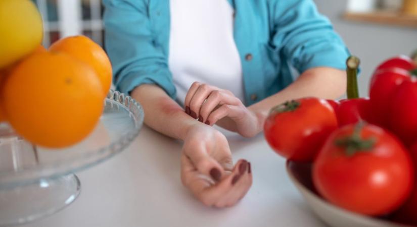 Erről ismerhető fel az ételallergia-kiütés
