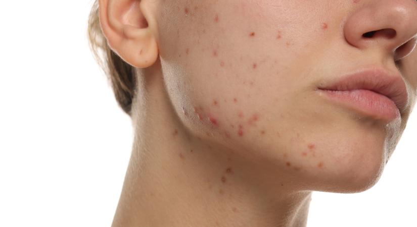 Kiütéseket okozhat az arcon a népszerű manikűr