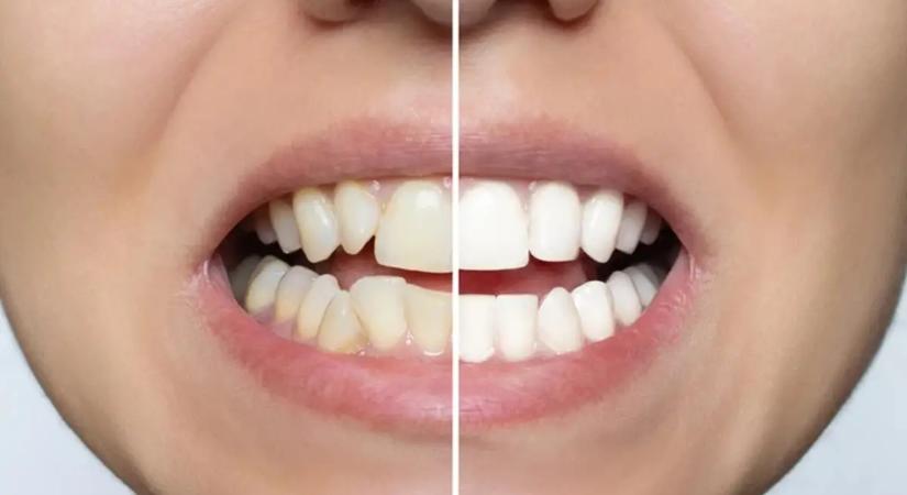 Otthoni megoldások fogfehérítésre – mi az, ami tényleg működik?