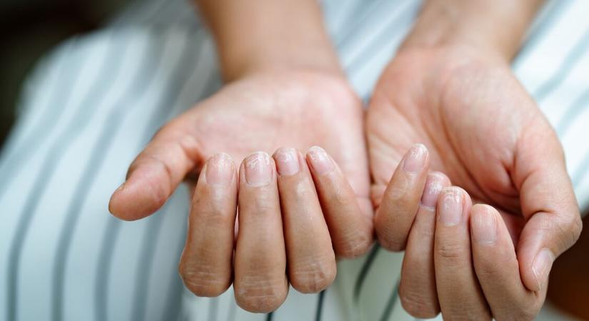 Ez a 7 jel a körmödön komoly betegséget jelezhet — mutatjuk, mikor fordulj orvoshoz