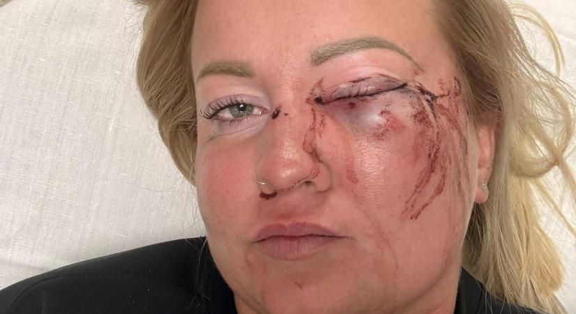 Úgy tűnik, politikai vita fajult brutális verésig, a szentmártonkátai alpolgármester által megütött nő az egyik szemére elvesztette a látását