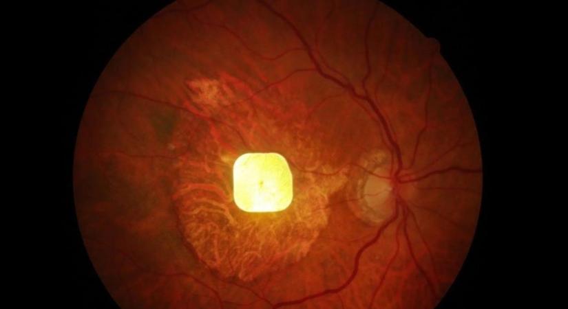 Milliók látását adhatja vissza egy új, kísérleti eszköz