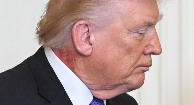 Rejtélyes vörös folt tűnt fel Donald Trump nyakán, a Fehér Ház orvosa nyilatkozatot adott ki