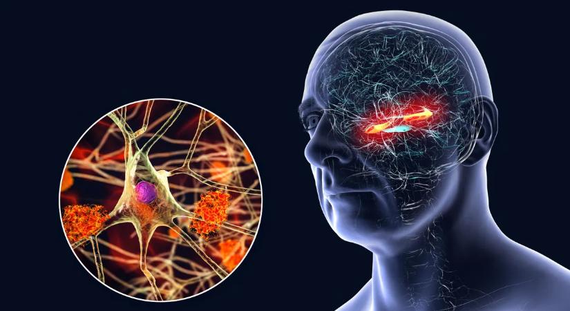 Megvan az Alzheimer-kór ellenszere? Jól ismert gyógyszer jelentheti a megoldást