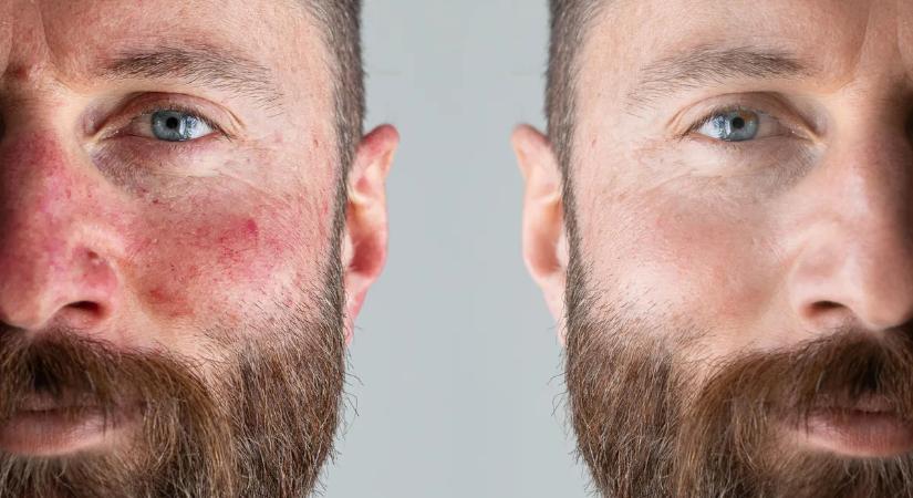 Krónikus bőrbetegség is okozhatja a borvirágos arcot