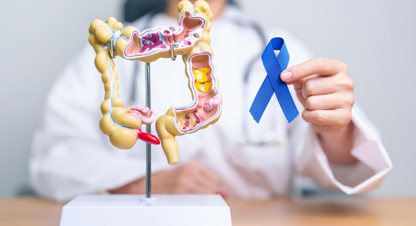 Vastagbélrák: ezek a korai árulkodó tünetek – Egyre több fiatalnál alakul ki a betegség