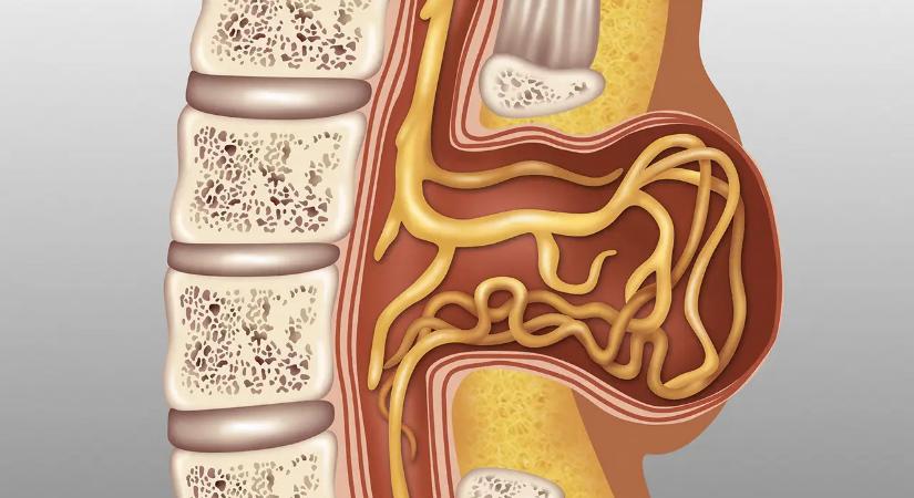 Őssejtterápia a nyitott gerinc gyógyítására