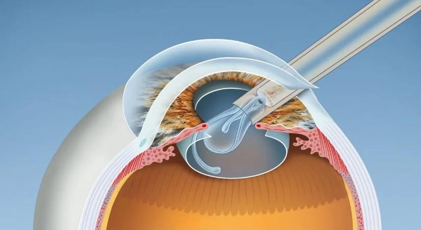 Gyógyíthatóvá válhat a vakság? Hihetetlen eszközt fejlesztettek