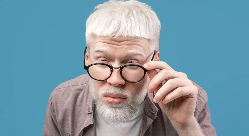 Albinizmus: amikor a szépség az egészség rovására megy