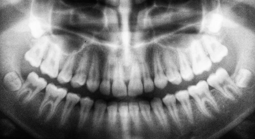 Fogfájásra panaszkodott a férfi, majd orvosa nem találta meg csontjait