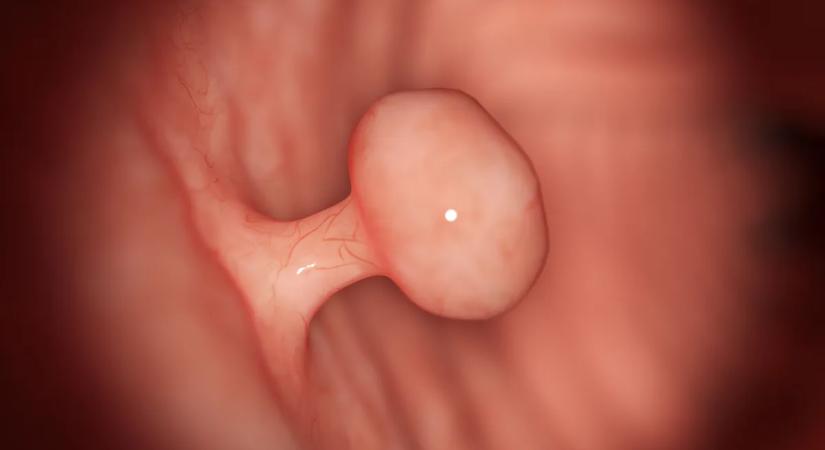 Ötszörös eséllyel lehet rákos, ha ilyen elváltozása van