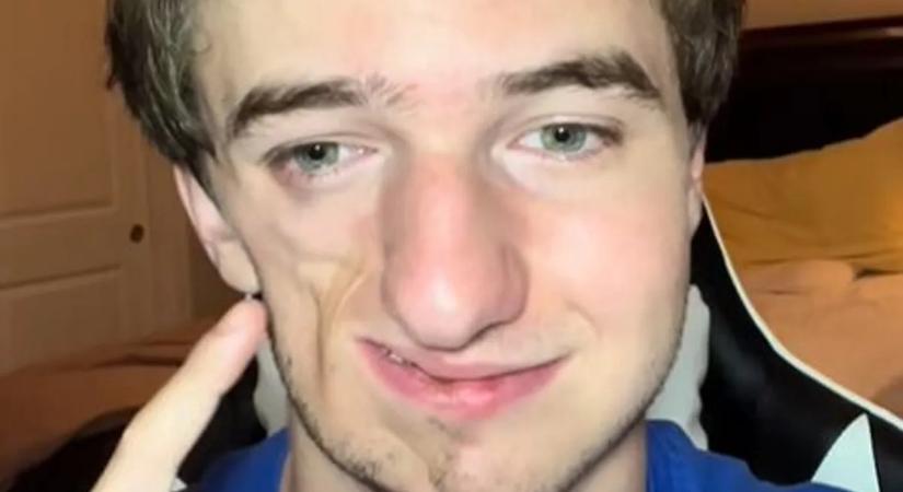 Elszíneződéssel kezdődött, évekig izomevő betegség ette arcát a gyermeknek