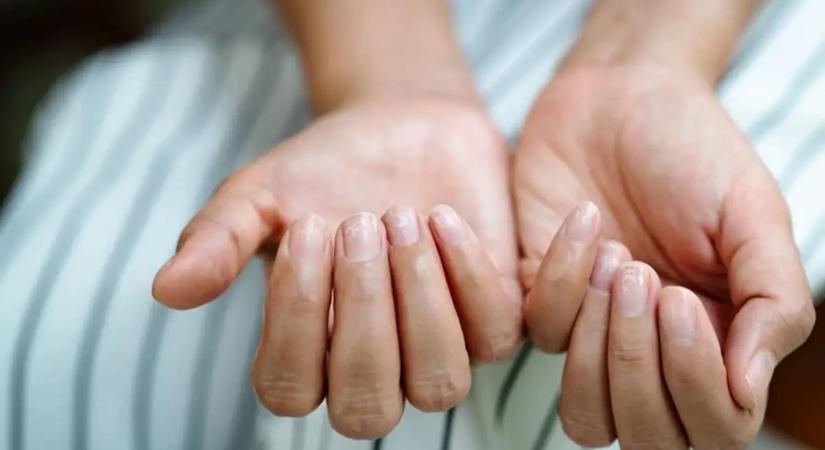 Ez a 7 jel a körmödön komoly betegséget jelezhet