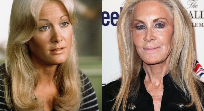 Elcsúfították a plasztikai műtétek a férfiak egykori kedvencét