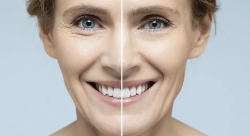 A kollagén feszesebbé teszi a bőrt - vajon véd a ráncok ellen is?