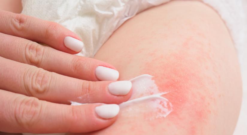 Mi okozza a hólyagos pelenkakiütést és hogyan kell kezelnünk?