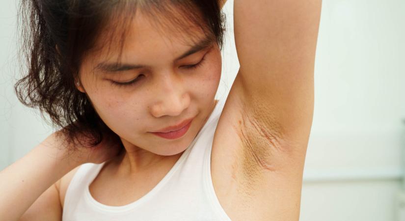 Ez az apró bőrelváltozás a cukorbetegség előjele lehet