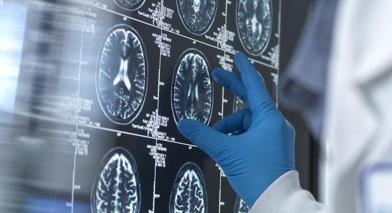 A Viagra lehet a kulcs az Alzheimer-kór kezelésében