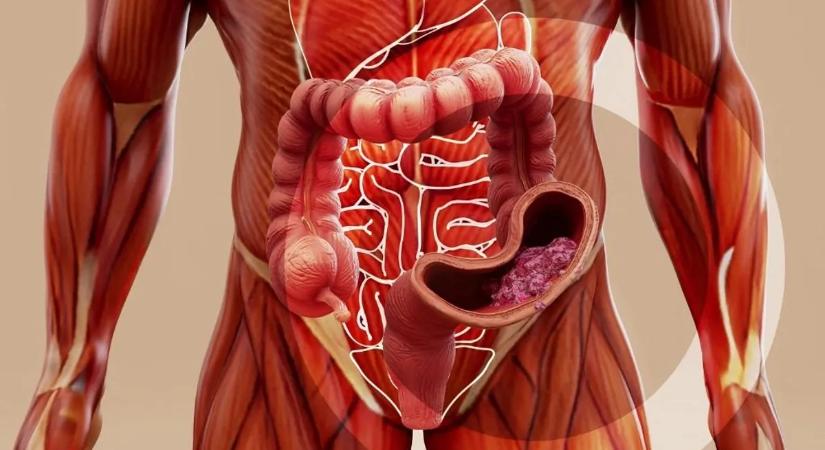 Egy egyszerű trükk, amely még a bélrák kockázatát is csökkentheti