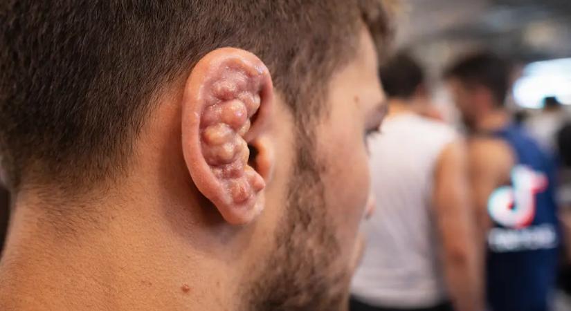 Veszélyes TikTok-trend terjed: a „karfiolfülért” kockáztatják az egészségüket a fiatalok