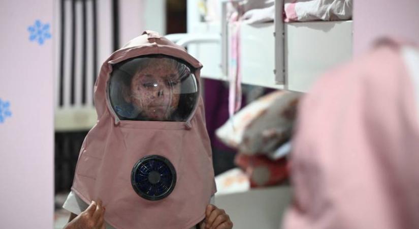 Űrhajós sapkában tudnak utcára lépni ezek a betegek: ritka és gyógyíthatatlan kórral élnek