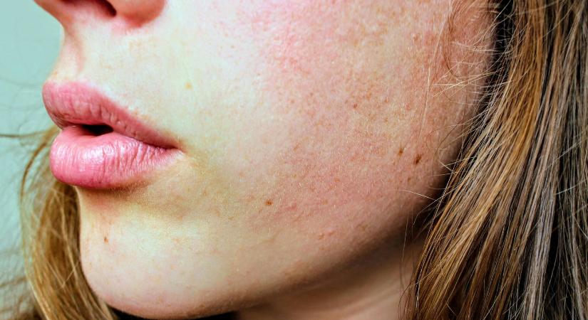 Érzékeny bőr és rosacea: Így nyugtasd meg a tavaszi szélben és allergiaszezonban kipirosodó arcot