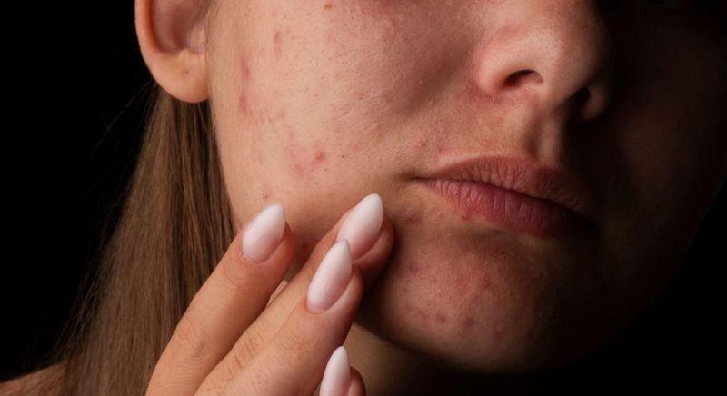 Soha ne nyomd ki a pattanásokat a "halálos háromszögben".