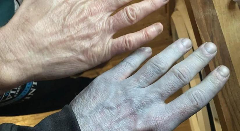 Egy éjszaka alatt kékült el a férfi – nem hiszi el, mi okozta az esetet!