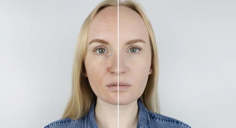 Ijesztő, mit művel a tavaszi nap a bőröddel – Így védekezz ellene