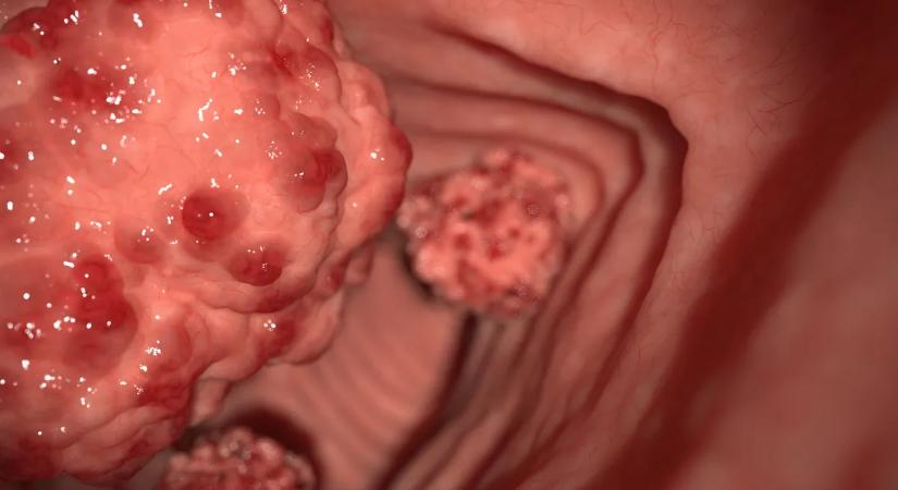 Sokkoló fordulat: megtalálták a fiatalokat gyilkoló rák rejtélyes okát