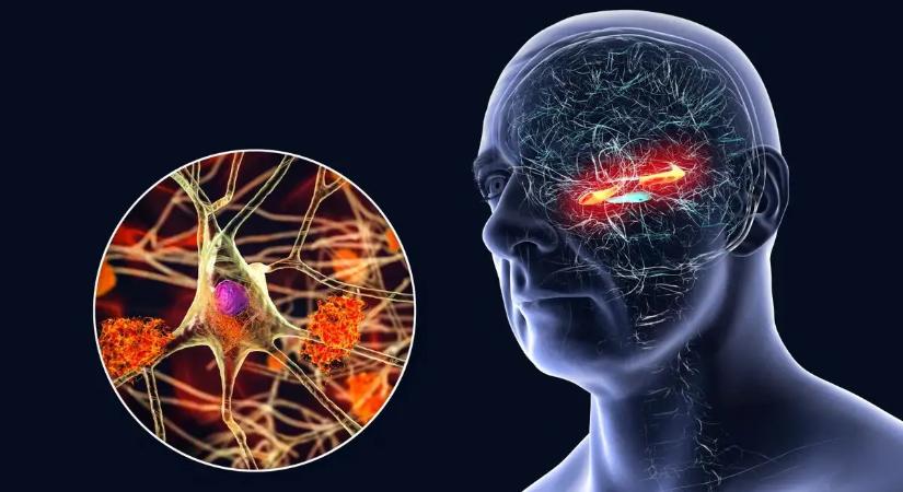 Megvan az Alzheimer-kór ellenszere? Jól ismert gyógyszer jelentheti a megoldást