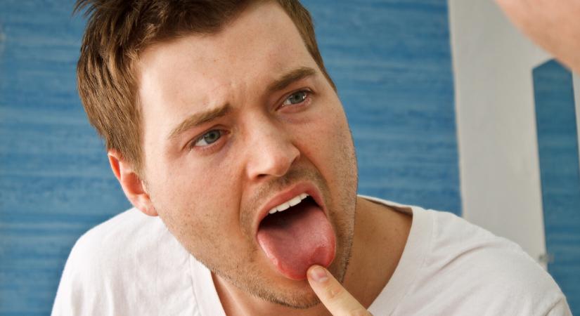 5 változás a nyelven, ami emésztési problémát jelezhet