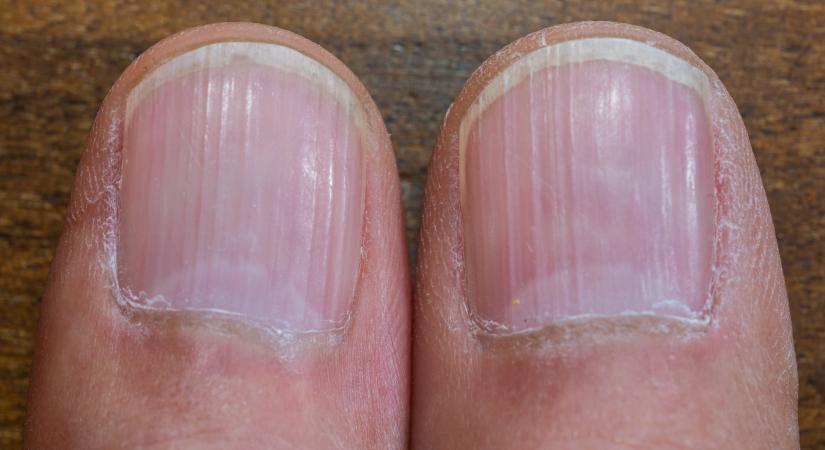 Szinte mindenkinek vannak ilyen vonalak a körmein, de csak kevesen tudják, mit jelentenek