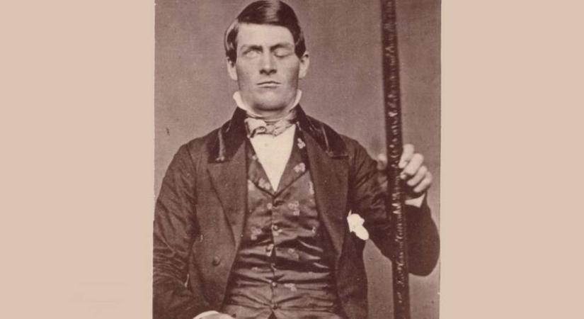 Egyméteres vasrúd fúrta át a férfi koponyáját: életben maradt, de furcsa dolgok történtek ezután